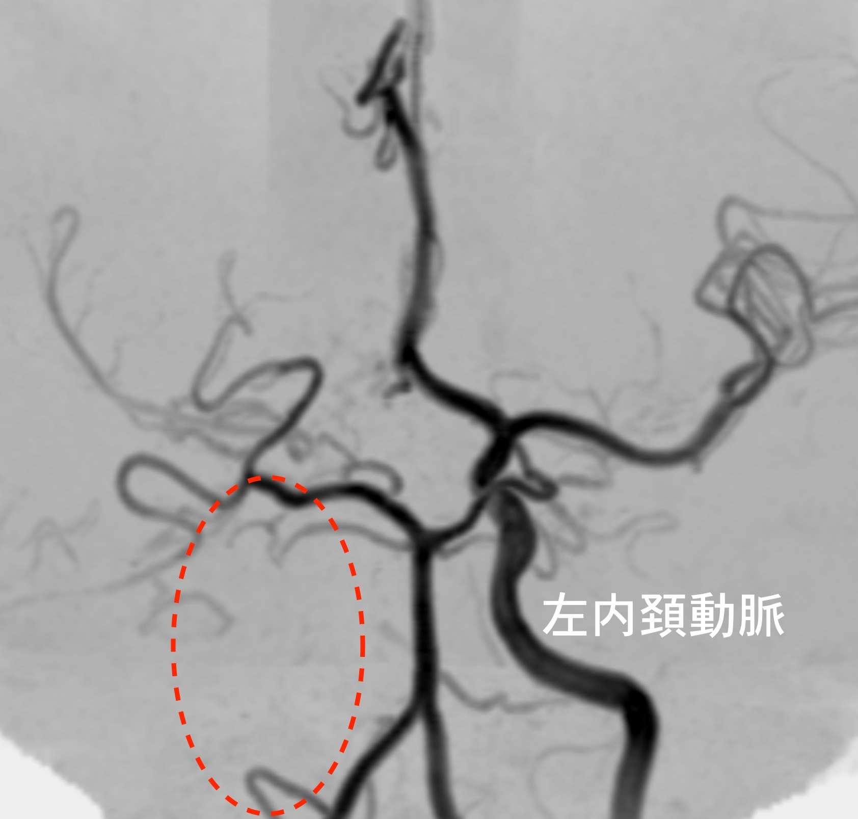 もやもや病と片頭痛